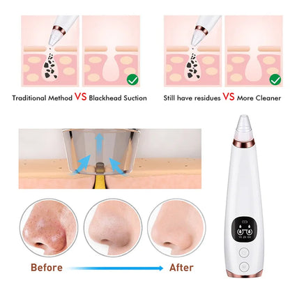 Lisa Blackhead Remover & Vacuum Pore Cleaner